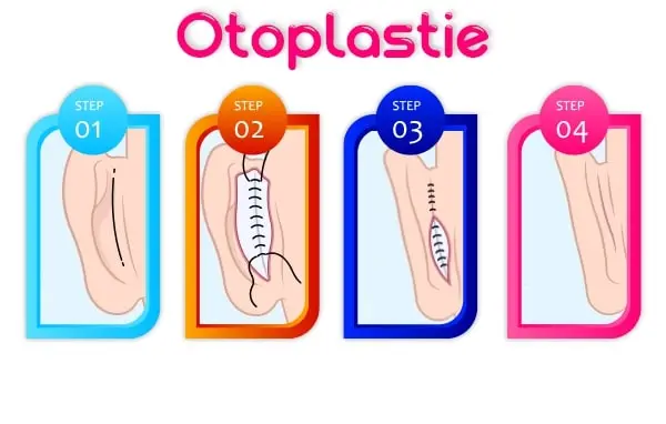 otoplastie