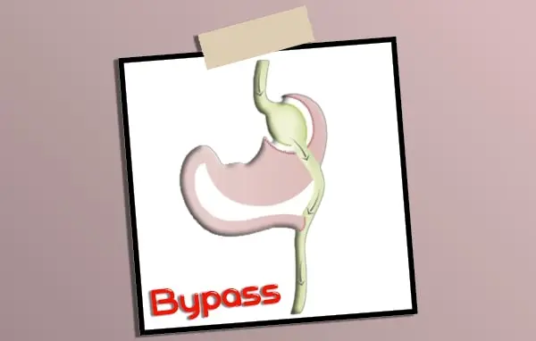 bypass gastrique