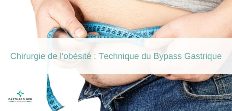 Bypass Gastrique Technique De Chirurgie De Lobésité 6025