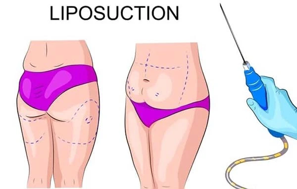 Liposuction