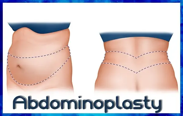 Abdominoplasty