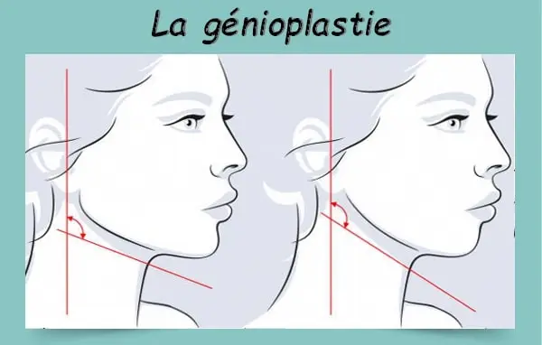 La génioplastie